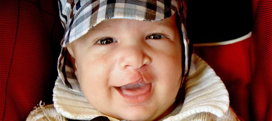 cleft palate treatment